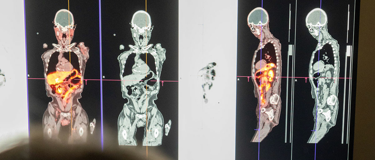 Full-body positron emission tomography images depicted on computer screen